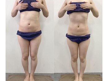 アイリーボーテ 東大阪(アイリーBEAUTE)/痩身