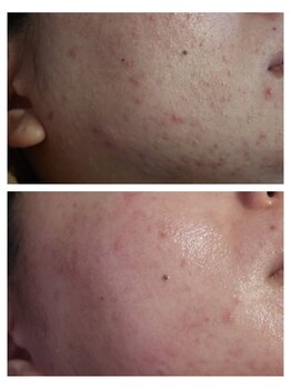 ベビースキン(baby skin)/ニキビ肌改善