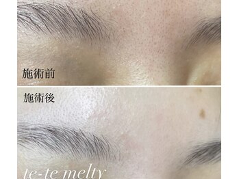 テテメルティ(te-te melty)/毛穴エクストラクション