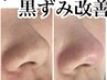 【毛穴の黒ずみ/ザラつき/皮脂詰まり】繰り返さない毛穴洗浄コース☆