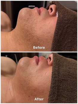 サロン ナビ(salon nabi.)/ひげ脱毛before→after♪