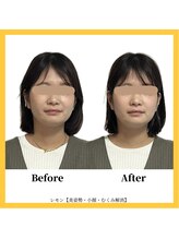 美容整体 レモン/ほうれい線ケア