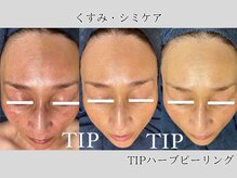 キー(kii)/くすみケア、シミケアにも！