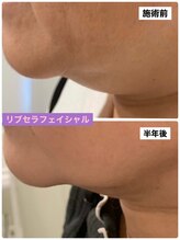 プリュネル(Prunelle)/プラズマシャワー