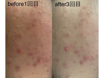 ユーアンドハニー(U&Honey.)/アフターケアも万全！ニキビケア