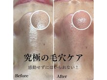 ピエル 北千住店(PIEL)/究極の毛穴ケア