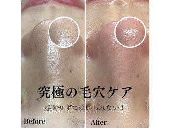 ピエル 北千住店(PIEL)/究極の毛穴ケア