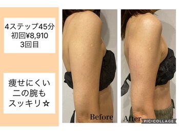 ハピネス(HAPPINESS)/4ステップメニュー　二の腕3回目