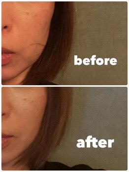 ことりと葉 平尾店/小顔調整ビフォーアフター！！