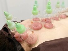 神門 整体院/カッピングで全身スッキリ♪