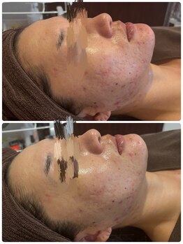 ミラヴィエ(Miravie)/LPS鎮静レストセル1回の施術結果