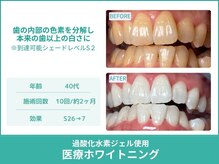 クレア(Crea)/【歯のホワイトニング症例写真】