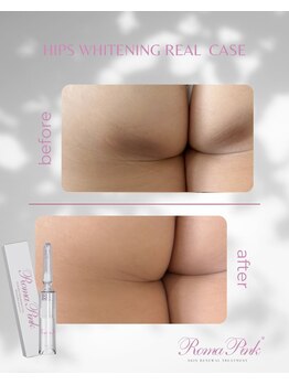 ココノワ(coconoix)/ローマピンク【ビキニライン】