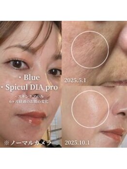 アンジー(an.g)の写真/40代・50代のハリ・つやＵＰを叶える韓国スピキュールダイヤで、しみしわくすみをケア☆