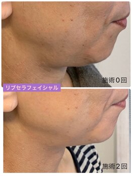 プリュネル(Prunelle)/プラズマシャワー