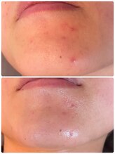 スペチアーレ 夙川/【RELIハーブピーリング】