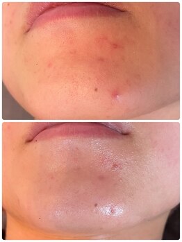 スペチアーレ 夙川/【RELIハーブピーリング】