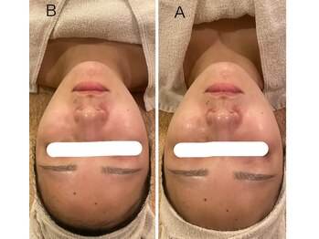 うつくし痩身 美サロン ゼットワン(Z-ONE)/フェイシャル　カーボキシーケア