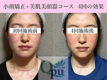 キュープ 表参道店(Qpu)/美顔器モニターコース4回の変化