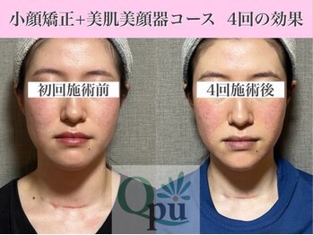 キュープ 表参道店(Qpu)/美顔器モニターコース4回の変化