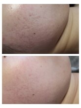 ベビースキン(baby skin)/肌改善