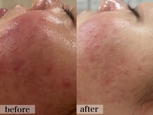 エステサロン ジョアアンジェ(joie ange)/アンストレス 2回