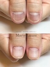 マリーロール 梅田店(Marie Laure)/自爪育成/深爪矯正/ネイルケア