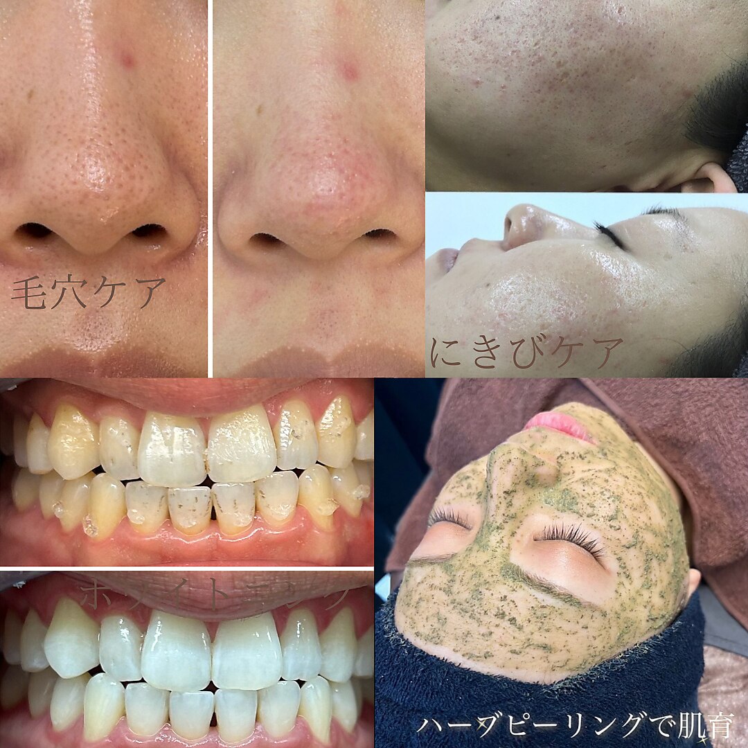 とらこさん専用　ハーブピーリング　10回分 とらこさん専用 ハーブピーリング 10回分 とらこさん専用 ハーブ