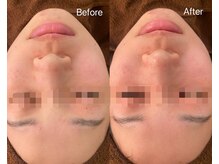 リアン(Lien)/毛穴洗浄ハイドロスプラッシュ