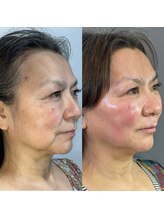 ラニー アンド ココネイル(LANIE&CocoNail)/大人のお悩みに！　Lit(リット)