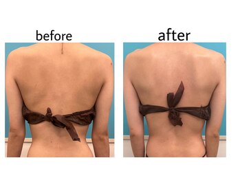 ブーティサロン(BOOTY SALON)/◇背中すっきりケア◇