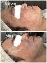 ルミネル 名古屋新栄(Luminelle)/エクソソーム・エラスチン