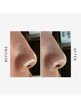 ヒヨリ(hiyori)/《before/after》毛穴洗浄