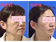 すぐに効果を実感できる定番造顔の【顔筋リフトマッサージ】