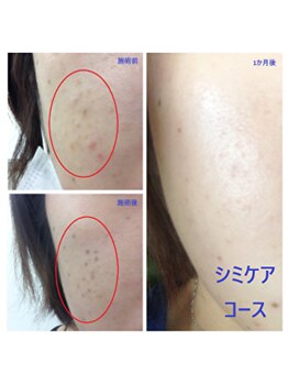 ヒトハダ(hitohada)/【beforafter】シミケア