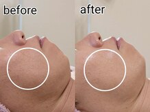 シャリル(charire)/毛穴つるんっ！瞬間美肌