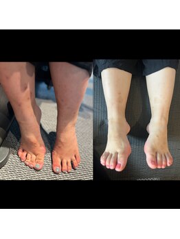 ハーモニーフィットネス 赤坂(Harmony Fitness)/謎の湿疹改善