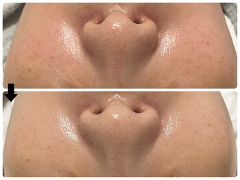 エフェクト 塚口店(effect)/Before After 30代/1回目