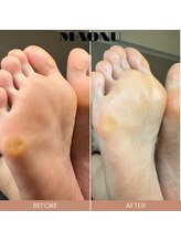 マオヌー(MAONU)/韓国式足裏角質ケア　症例写真