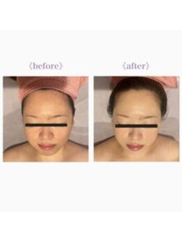 ライゼ(REISE)/ビフォーアフター【ニキビ】