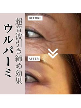 小顔ウナ学芸大学店(UNA)/ウルパーミ☆ビフォアアフター