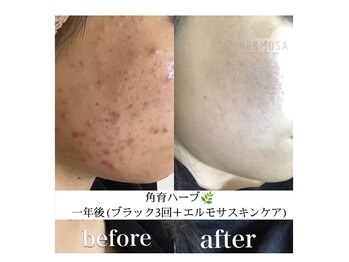 トゥルプ(TULIP)/毛穴詰まり・ニキビ・黒ずみ