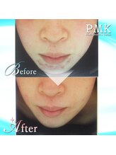 PMK 上野店/フェイシャルケア15回