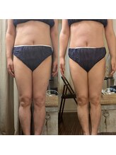 グラン ジュテ/エクソソーム注入お腹とラジオ波