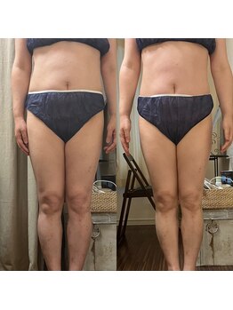 グラン ジュテ/エクソソーム注入お腹とラジオ波