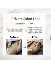 ラニ(Lani)/うなじ（襟足）脱毛