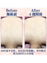 カラフル(caratful)/うなじ・背中脱毛 Before After 