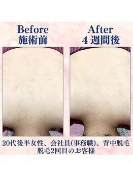 カラフル(caratful)/うなじ・背中脱毛 Before After 