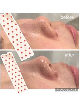 リライフ(ReLIFE)/韓国肌管理☆毛穴洗浄ララピール