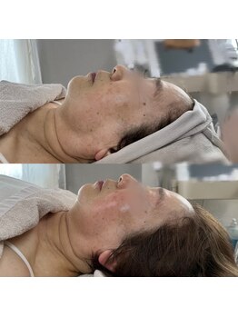 ルアンビューティー メディカルプラス(Luan beauty MEDICAL+)/【ビフォアフ】チタニウムリフト